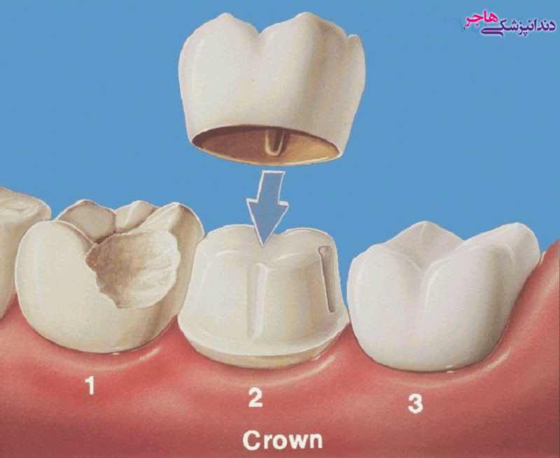  از روکش دندان برای ترمیم شکستگی دندان یا جلوگیری از ساییدگی شدید آن استفاده می شود